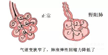 【世界慢阻肺日】让呼吸保持“通畅”!